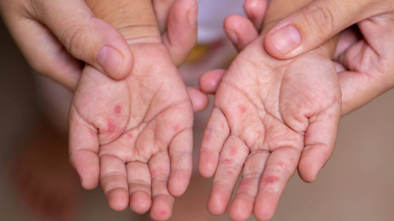 Kızamık ve Boğmaca Salgını Tehdidi: Aşısızlık Oranı Yüzde 10’u Geçti